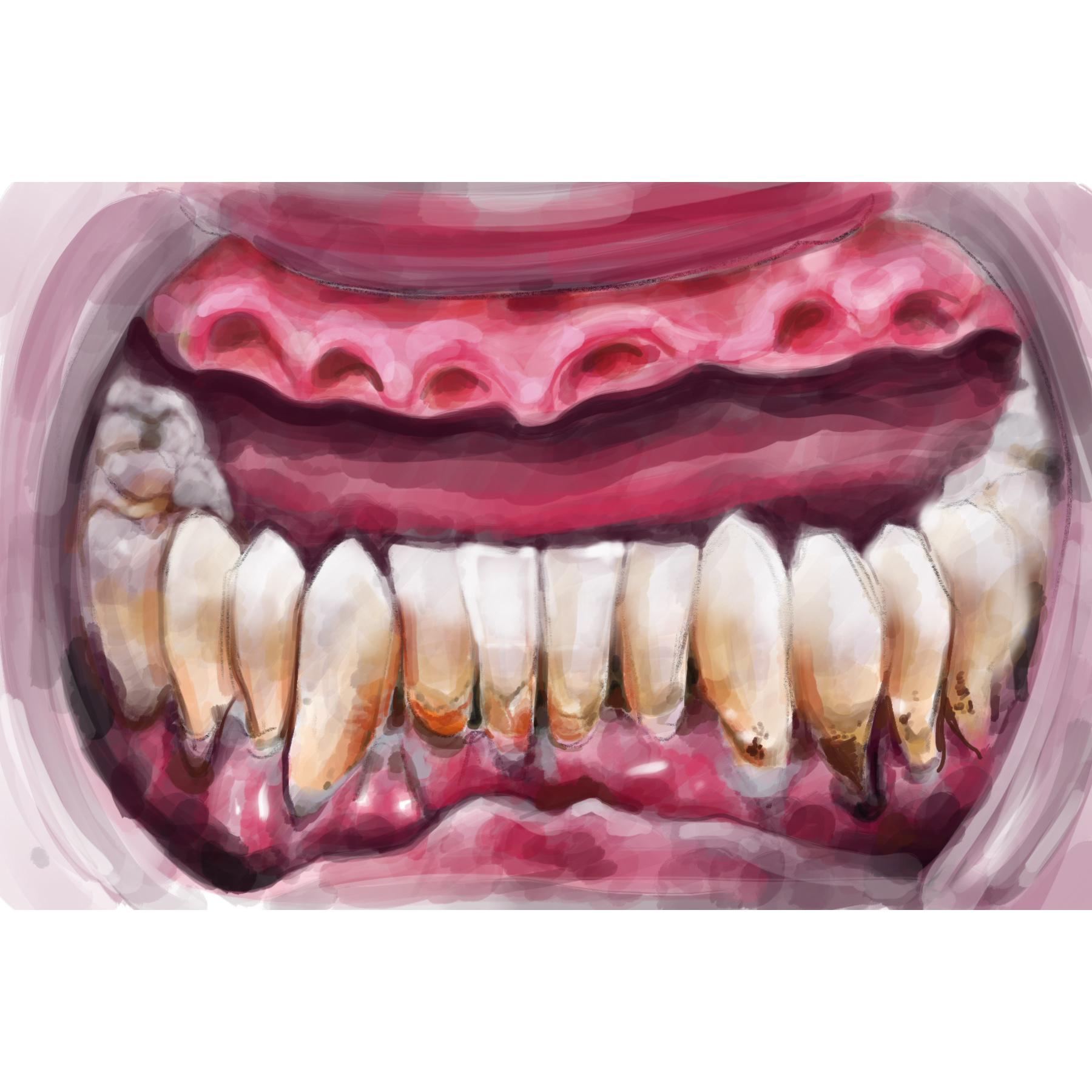 В чем же отличие атравматичного удаления зуба от обычного?