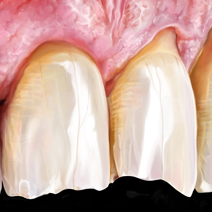 Почему появляются трещины на зубах?