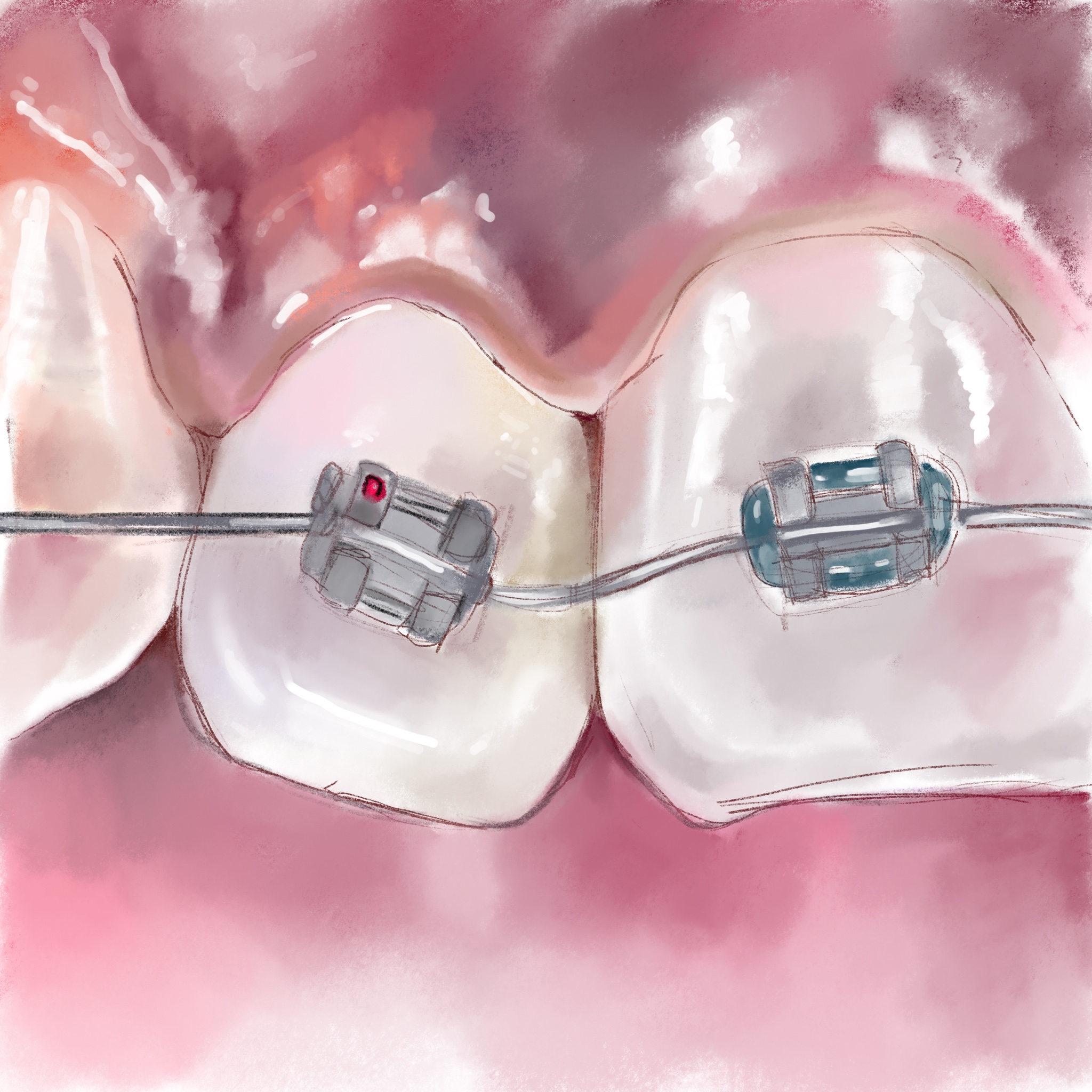 Уход за зубами при установленных брекет-системах
