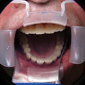 4. Винтовая конструкция с винирами в области 13, 12, 22, 23 зубов 