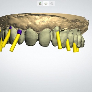 4. Винтовая конструкция с винирами в области 13, 12, 22, 23 зубов 
