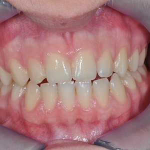 1. Винир E.max (11 зуб)