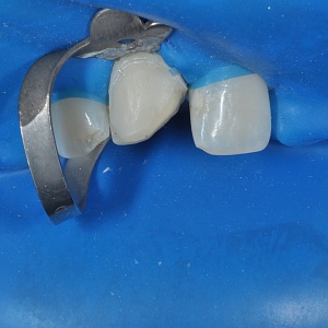 1. Винир E.max (11 зуб)