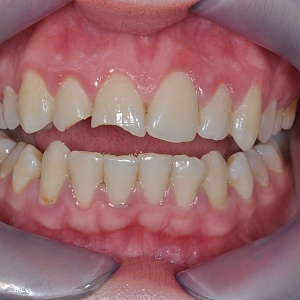 2. Виниры E.max (11,12 зубы)