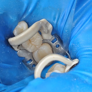 3. E.max inlay (46 зуб)